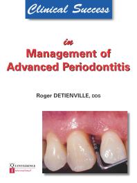 Clinical success in management of advanced periodontitis